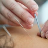 image showing someone performing acupuncture on another person