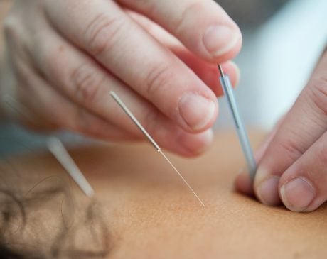 image showing someone performing acupuncture on another person